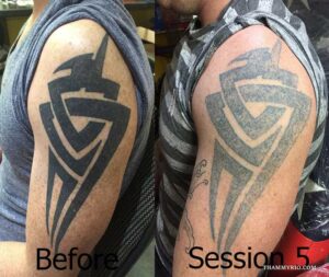 A male bicep showing dark tattoo removal before and after 5 laser sessions.