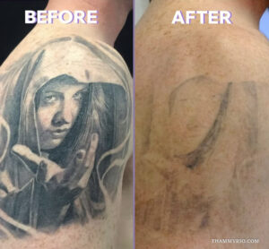 Dark tattoo removal before and after showing faded portrait tattoo on shoulder.