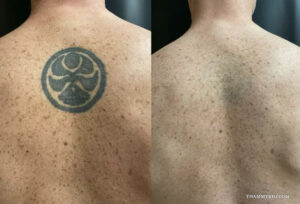 Dark tattoo removal before and after showing a faded circular back tattoo.