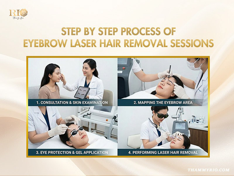 Four-step professional eyebrow laser hair removal process: consultation, mapping, eye protection, and laser treatment.