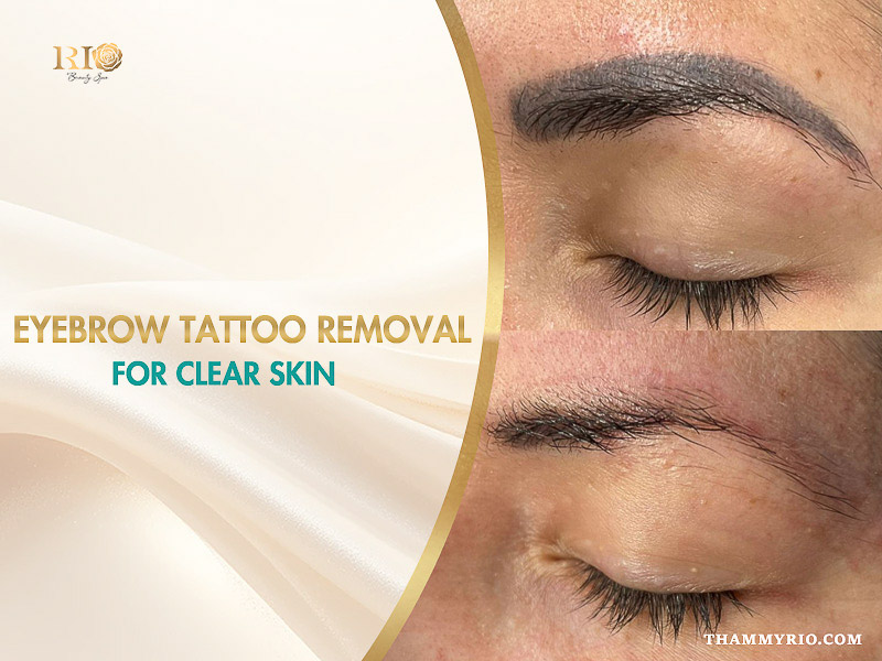 Before and after results of eyebrow tattoo removal at Rio Beauty Spa.