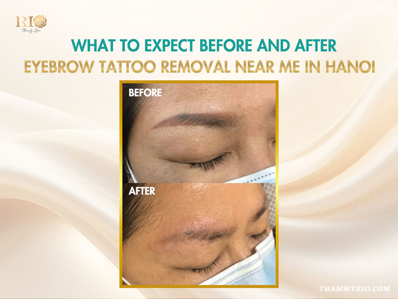Before and after laser eyebrow tattoo removal near me in Hanoi results at Rio Beauty Spa.