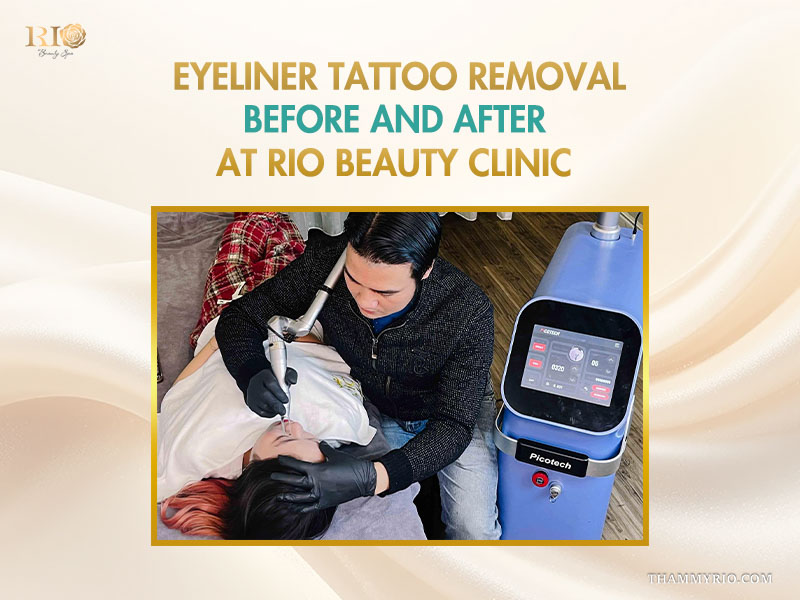Eyeliner tattoo removal before and after poster