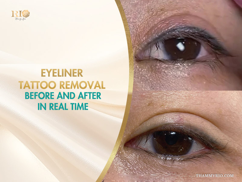 Eyeliner tattoo removal before and after laser