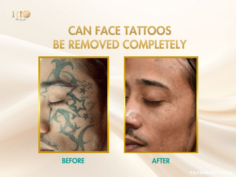 Before and after comparison of a successful face tattoo removal treatment on a man's face.