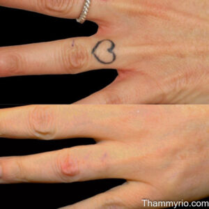 Hand tattoo removal before and after showing a black heart outline fading on the finger.