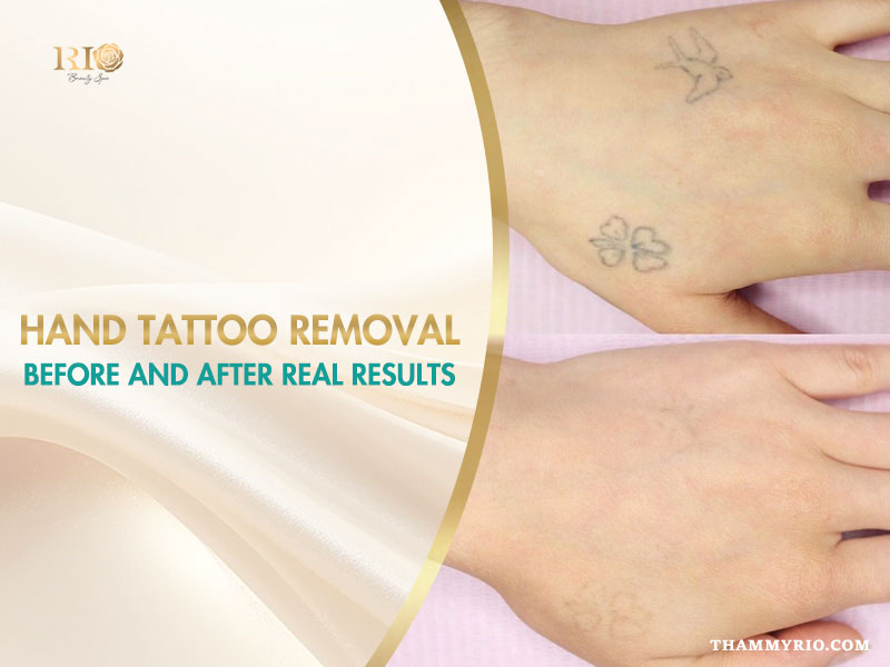 Professional hand tattoo removal before and after results for bird and clover tattoos.
