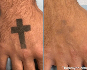 Hand tattoo removal before and after showing a black cross tattoo fading on the back of the hand.