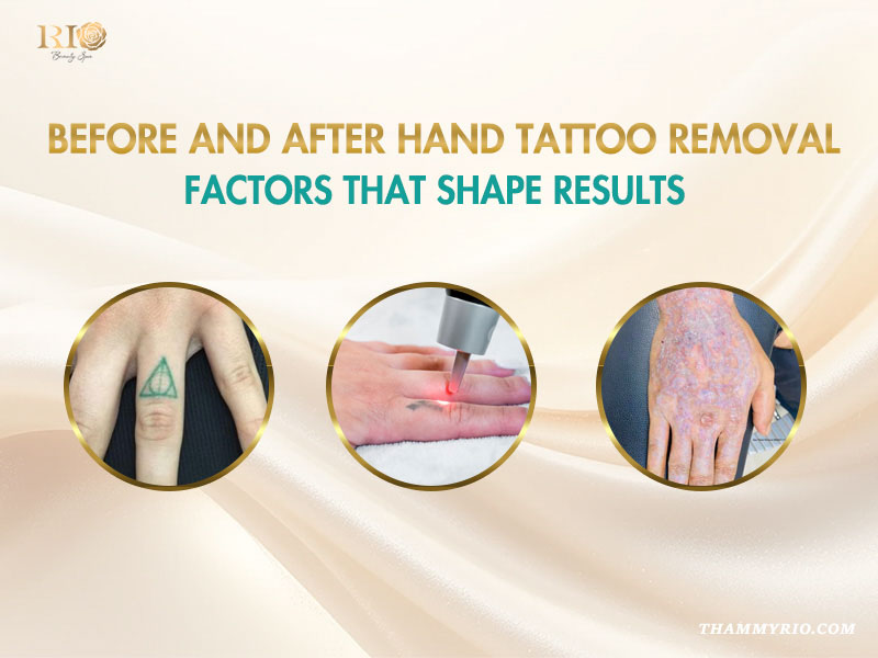 Hand tattoo removal before and after process showing laser treatment on finger and final healing results.