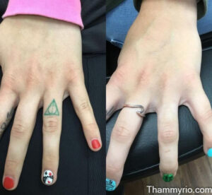 Hand tattoo removal before and after showing a finger tattoo complete disappearance.