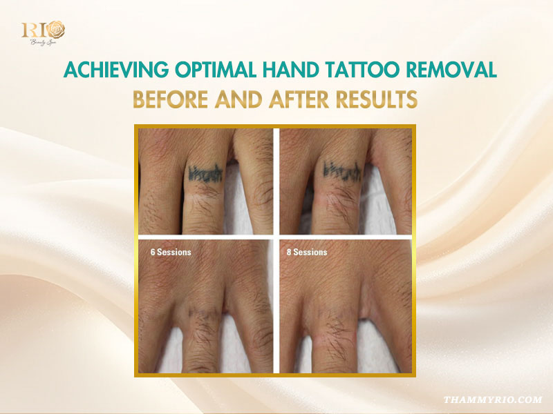 Hand tattoo removal before and after showing progress after 6 sessions and 8 sessions on a finger.