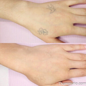 Hand tattoo removal before and after showing faded bird and clover tattoos on the back of the hand.