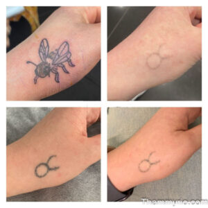 Hand tattoo removal before and after showing a bee design and a small symbol fading over time.