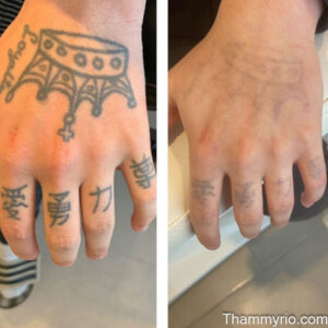 Hand tattoo removal before and after showing a crown and Asian characters fading on the back of the hand.