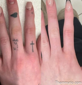 Hand tattoo removal before and after real results - Thẩm Mỹ Rio Beauty Clinic