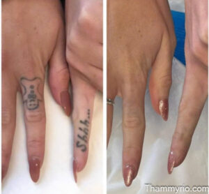 Hand tattoo removal before and after showing a gingerbread man and Shhh text fading on fingers.