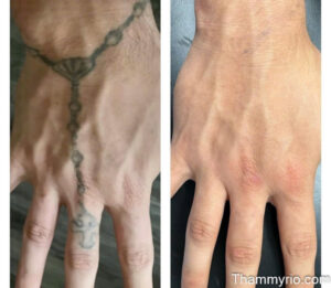 Hand tattoo removal before and after showing a rosary beads design disappearing from the back of the hand and finger.