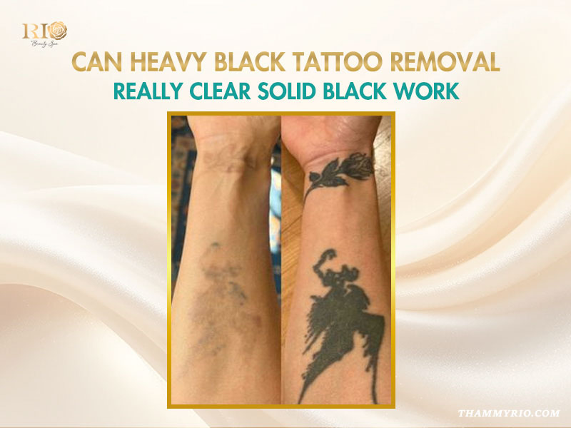 Before and after results of heavy black tattoo removal on a forearm using advanced laser technology.