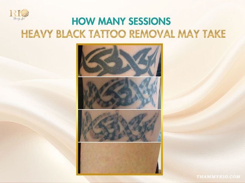A step by step progression of heavy black tattoo removal showing tribal ink fading over multiple sessions.