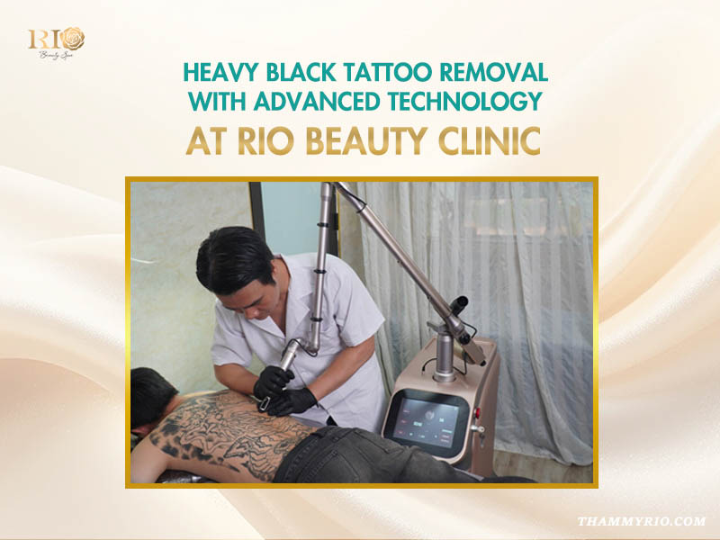 A technician performing heavy black tattoo removal using advanced laser technology on a client's full back at Rio Beauty Clinic.