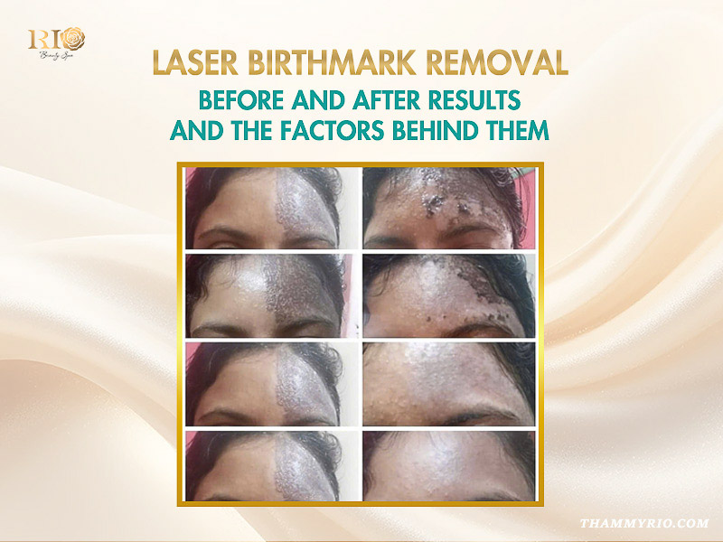 Laser birthmark removal before and after results on patient's forehead.
