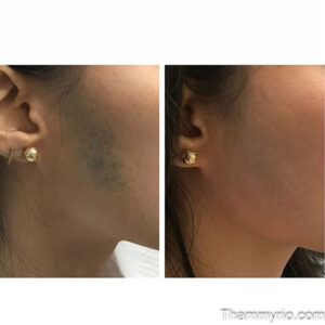 Laser birthmark removal before and after results on cheek area.