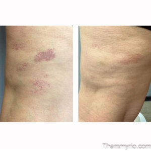 Laser birthmark removal before and after results for vascular lesions on the body.