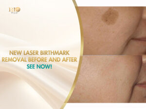 Laser birthmark removal before and after results on facial skin.