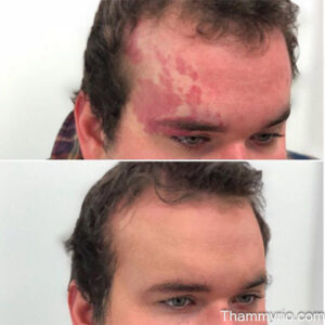 Laser birthmark removal before and after for port-wine stain on forehead.