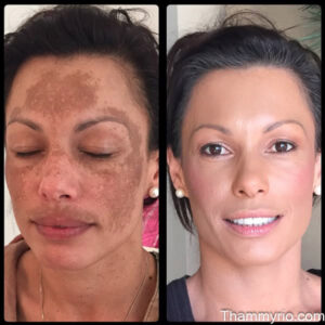 Laser birthmark removal before and after for facial hyperpigmentation.