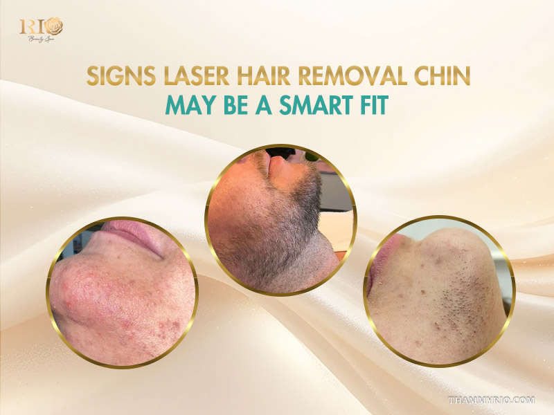Three circular close up images showing skin irritation thick stubble and ingrown hairs before laser hair removal for chin hair.