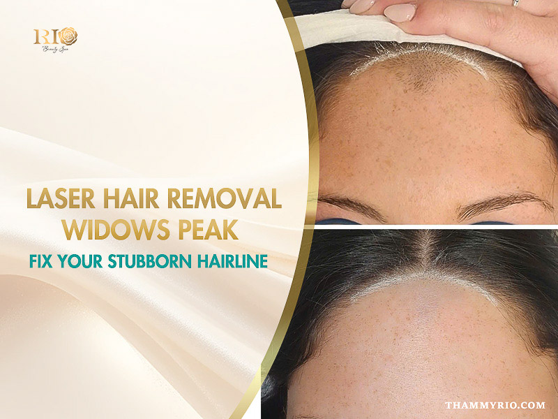 Before and after results of laser hair removal widows peak treatment at Rio Beauty Clinic to reshape a stubborn hairline.