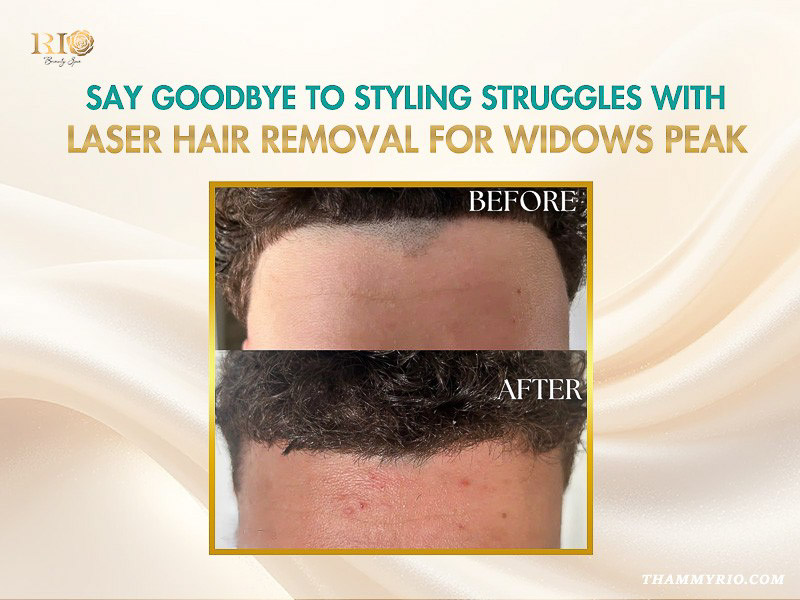 Hairline correction using laser hair removal widows peak treatment for a clean male forehead line.