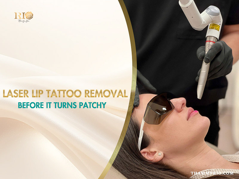 Laser lip tattoo removal treatment performed on a female client at Rio Beauty Spa.