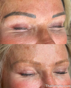 Close up before and after laser removal eyebrows showing dark ink fading to light brown.