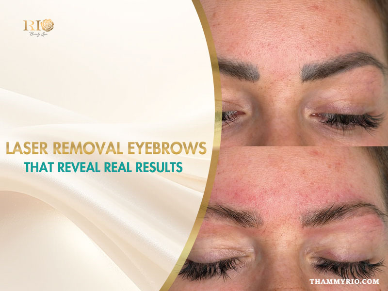 Professional laser removal eyebrows before and after results at Rio Beauty Spa.