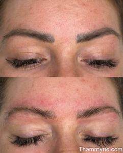 Before and after comparison of laser removal eyebrows showing effective ink clearing.