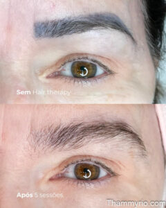 Laser removal eyebrows progress after 5 sessions showing ink fading and hair preservation.