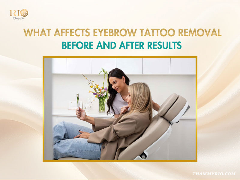 Professional consultation for laser removal eyebrows at Rio Beauty Spa.