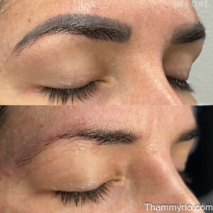 Real results of laser removal eyebrows showing total clearance of dark ink.