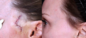 Side view comparison showing laser scar removal before and after results for a surgical stitch scar near the temple and hairline.