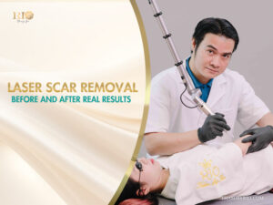Professional aesthetician performing laser scar removal before and after treatment on a client at Rio Beauty Spa.