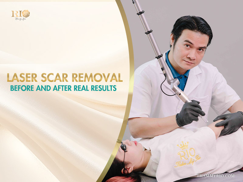 Professional aesthetician performing laser scar removal before and after treatment on a client at Rio Beauty Spa.