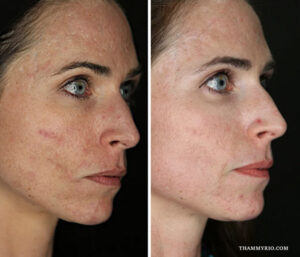 Side profile comparison of a woman's facial skin showing laser scar removal before and after results for acne scarring and skin texture improvement.