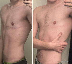 Side view comparison showing laser scar removal before and after results on a male chest surgical scar.