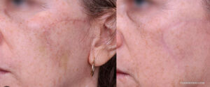 Close up comparison of laser scar removal before and after results on a woman's cheek showing faded surgical or injury scars.