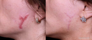 Laser scar removal before and after real results - Thẩm Mỹ Rio Beauty Clinic