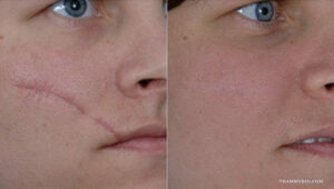Close-up comparison of a long facial scar on a woman's cheek showing laser scar removal before and after results with near-total clearance.