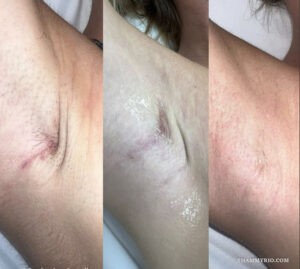 Three-step progression of laser scar removal before and after treatment for a deep underarm scar showing gradual healing and skin smoothing.