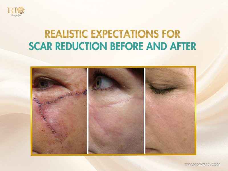 Three-stage progression showing laser scar removal before and after results for deep facial surgical stitches and scarring.